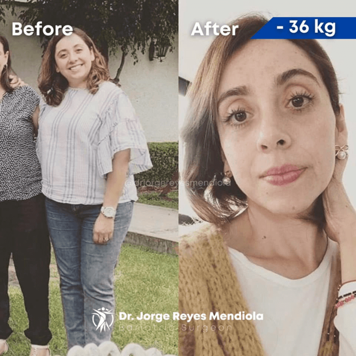 Dr. Reyes Mendiola - Before and After