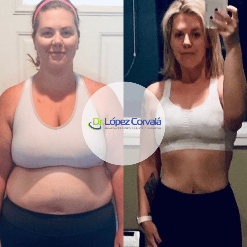 Dr. Corvala - Before and After - Gastric Sleeve