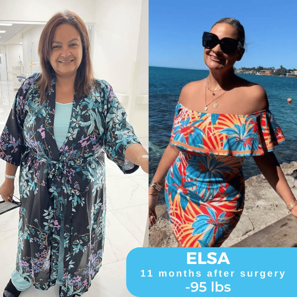 Elsa Before & After Bariatric Surgery