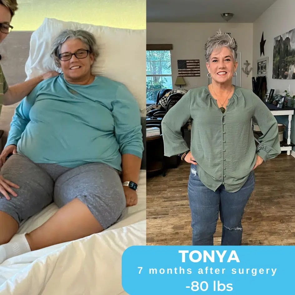 Tonya Before & After Bariatric Surgery