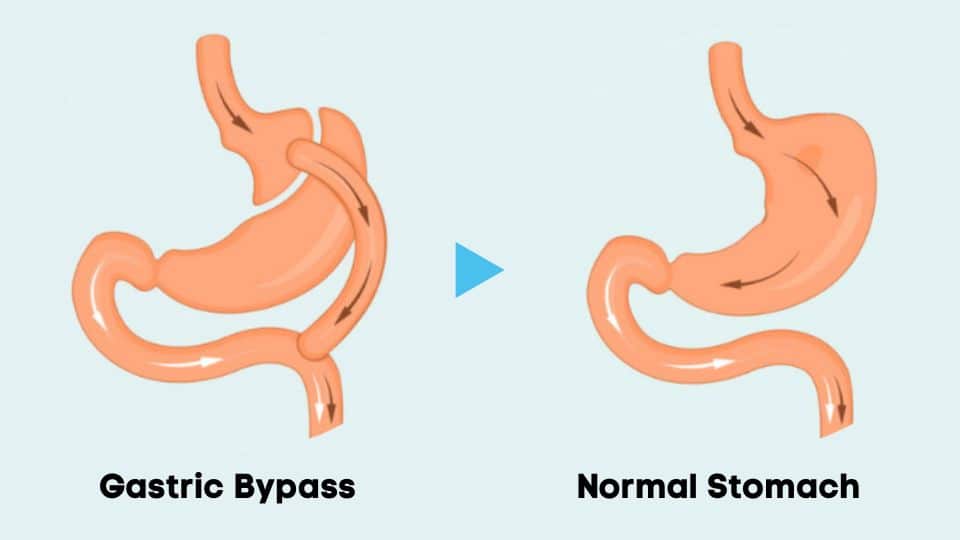 Everything You Need to Know About Reversing a Gastric Sleeve