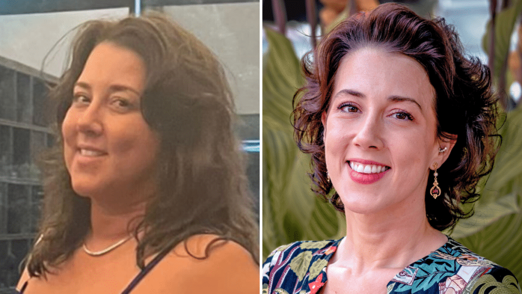 Before and after transformation of a satisfied client following a cost-effective gastric sleeve weight loss surgery in Tijuana, Mexico, with TreVita