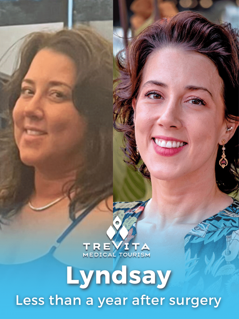 Before and after photo of Lyndsay's successful weight loss surgery in Mexico, showcasing her impressive transformation less than a year post-operation. Affordable weight loss surgery in Mexico cost from TreVita