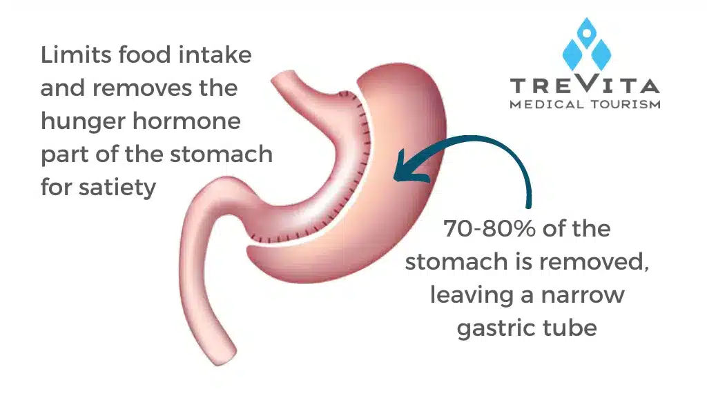 The Gastric Sleeve Procedure