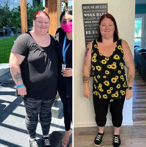 Excess Body Weight Reduction