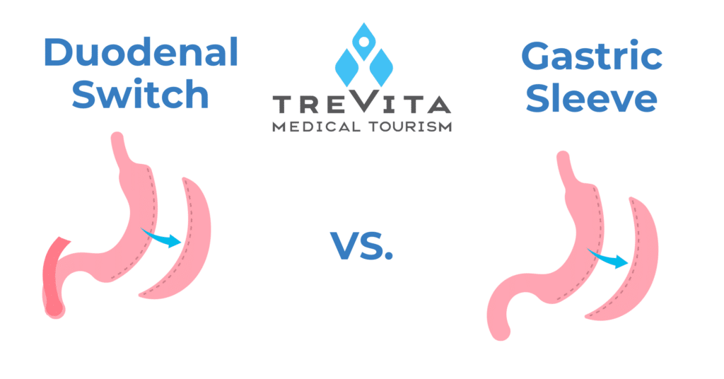comparing the benefits of getting duodenal switch surgery versus gastric sleeve surgery