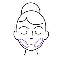 Bichectomy Illustration