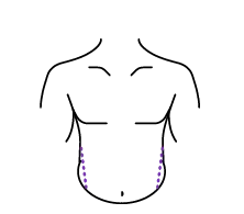 Liposuction
