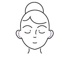 Otoplasty Illustration