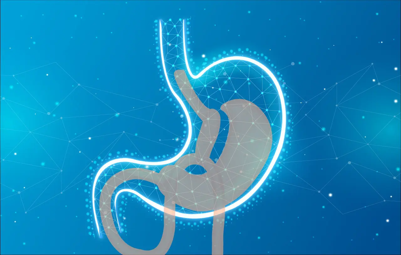 Mini Gastric Bypass