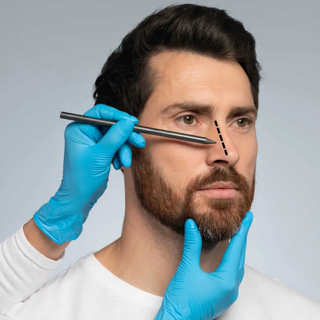 Rhinoplasty