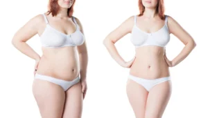 Top Factors To Consider When Selecting A Mommy Makeover Surgeon In Mexico