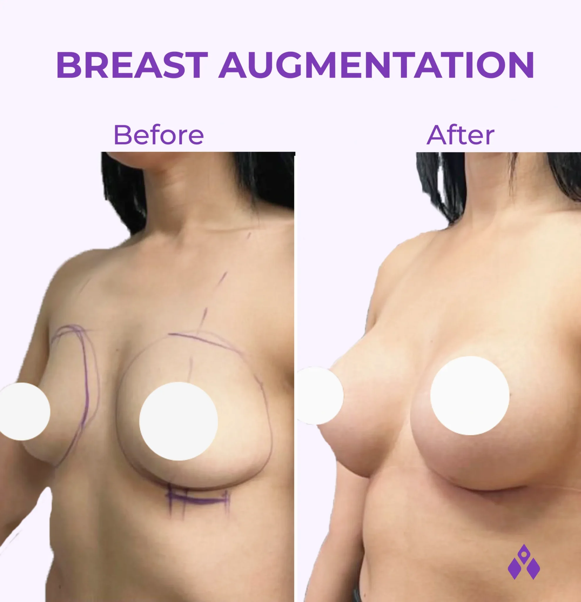 Consultation For Breast Implants In Kl