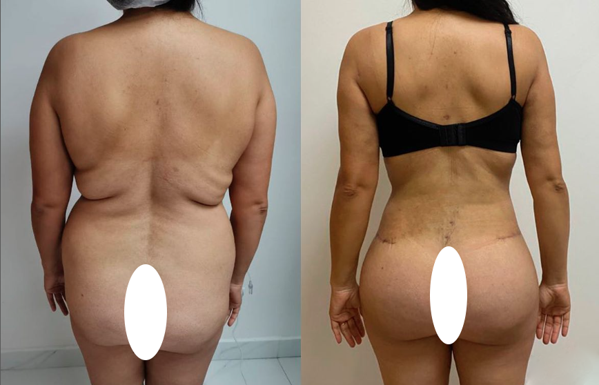 32e6fdc9-46f8-42b0-89c5-69e5a091146a-mommy-makeover-back