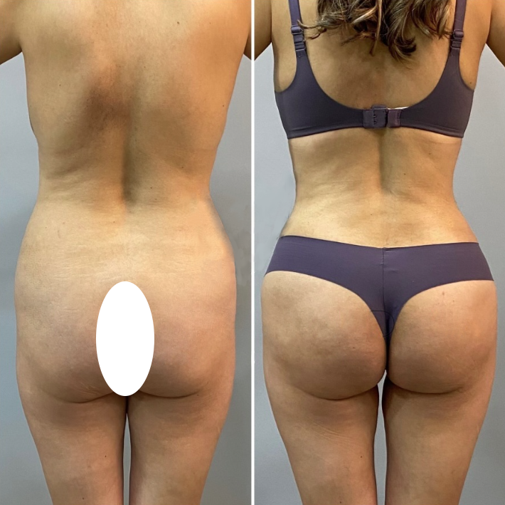 4a269edf-d2e1-46ec-a88b-0a66604e049f-mommy-makeover-back-1