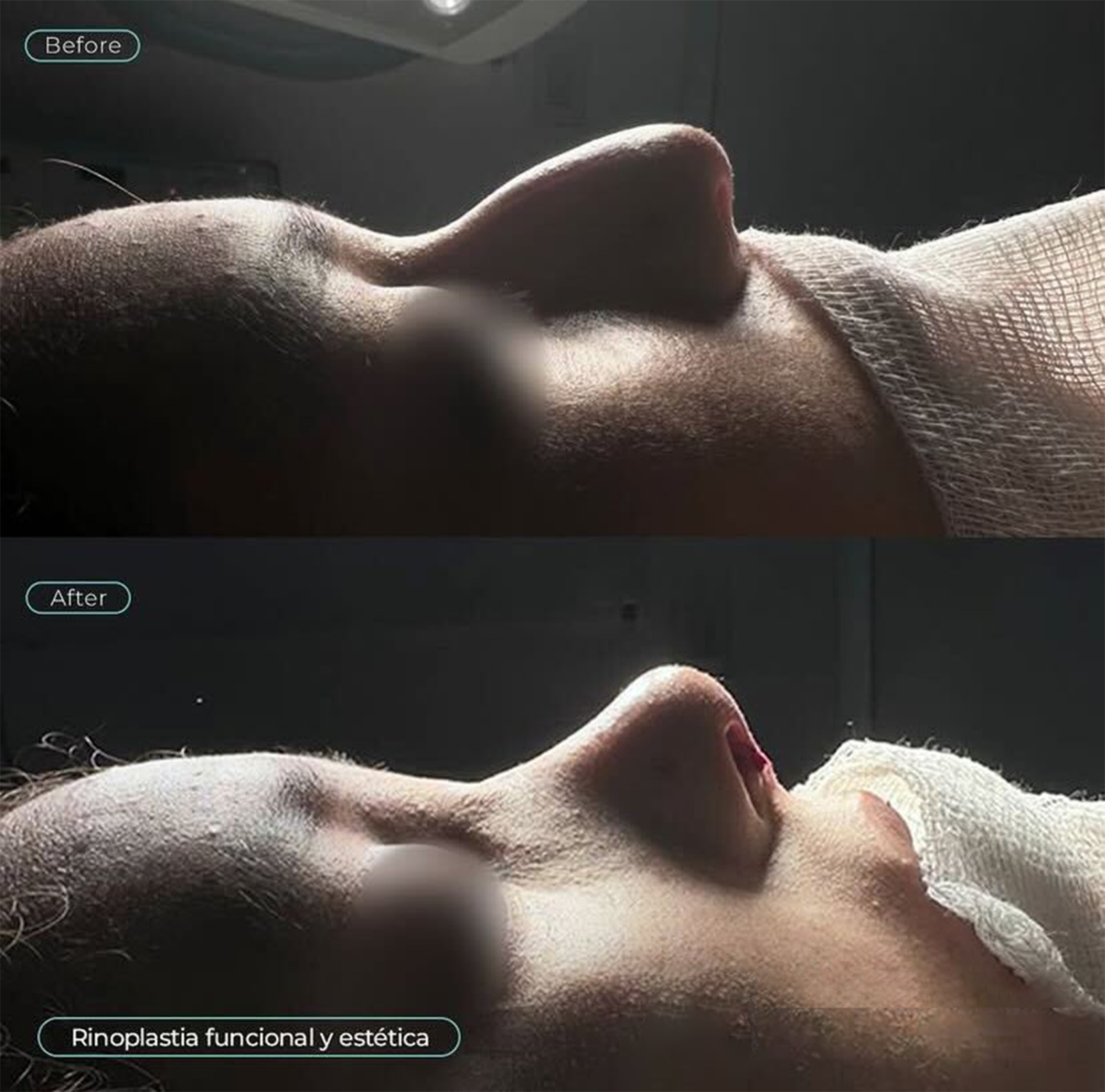 767ad14a-4e4a-4f4e-8994-3a19d12f319c-dr-munoz-rhinoplasty-2x