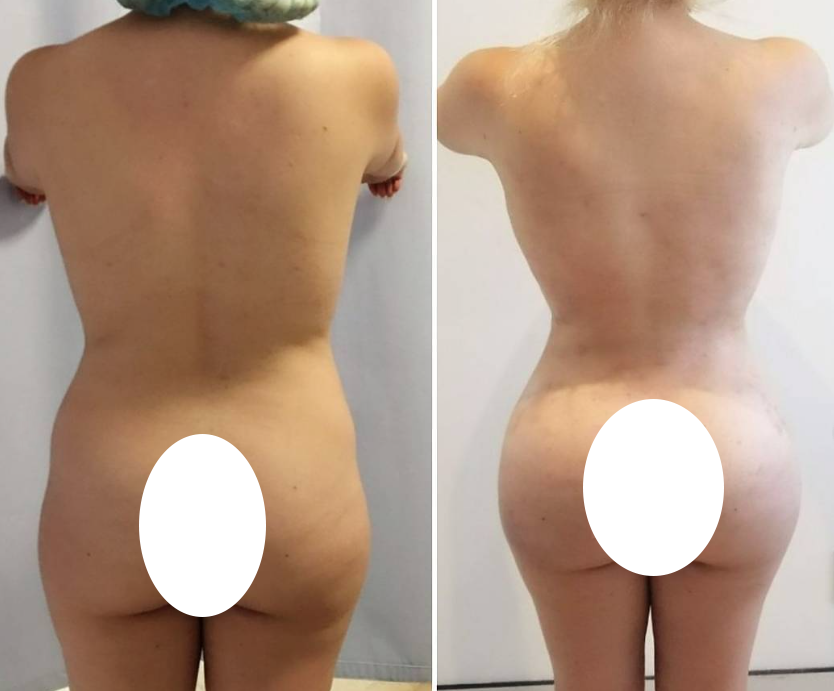 9776d060-2d5c-4651-81d1-6dc8c09799b9-mommy-makeover-back-3