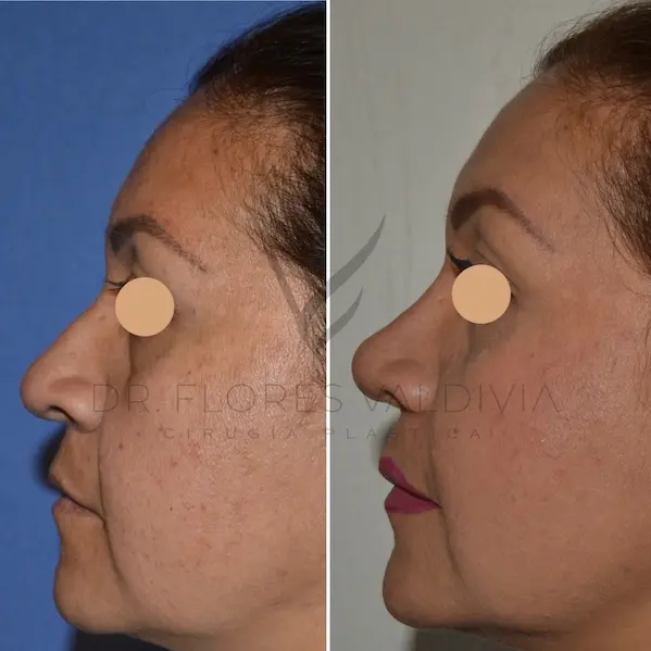 Dr-Flores-Rhinoplasty-2
