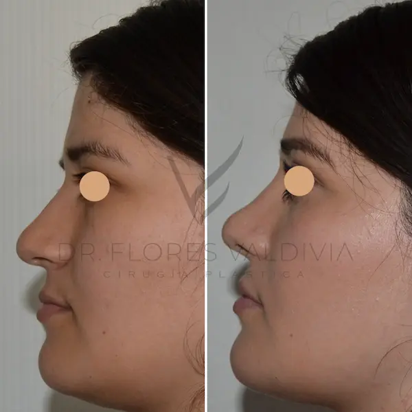 Dr-Flores-Rhinoplasty