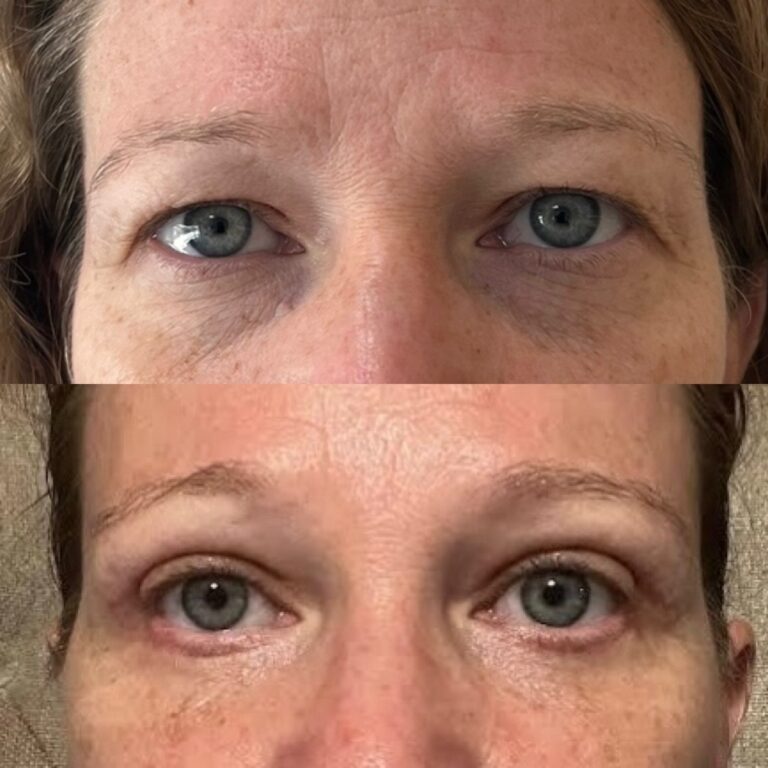 Dr Rodriguez Eyelid
