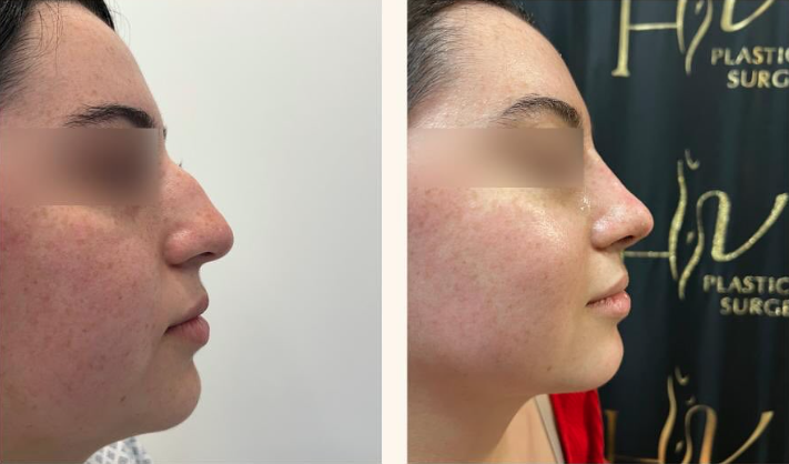 Female-Rhinoplasty