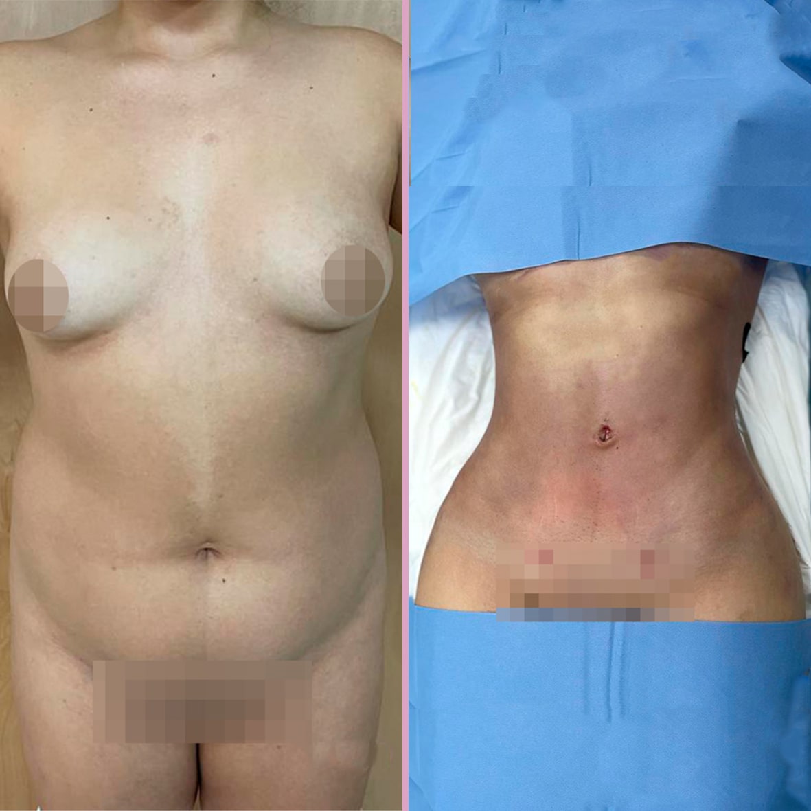 Liposuction Dr Rodriguez 1