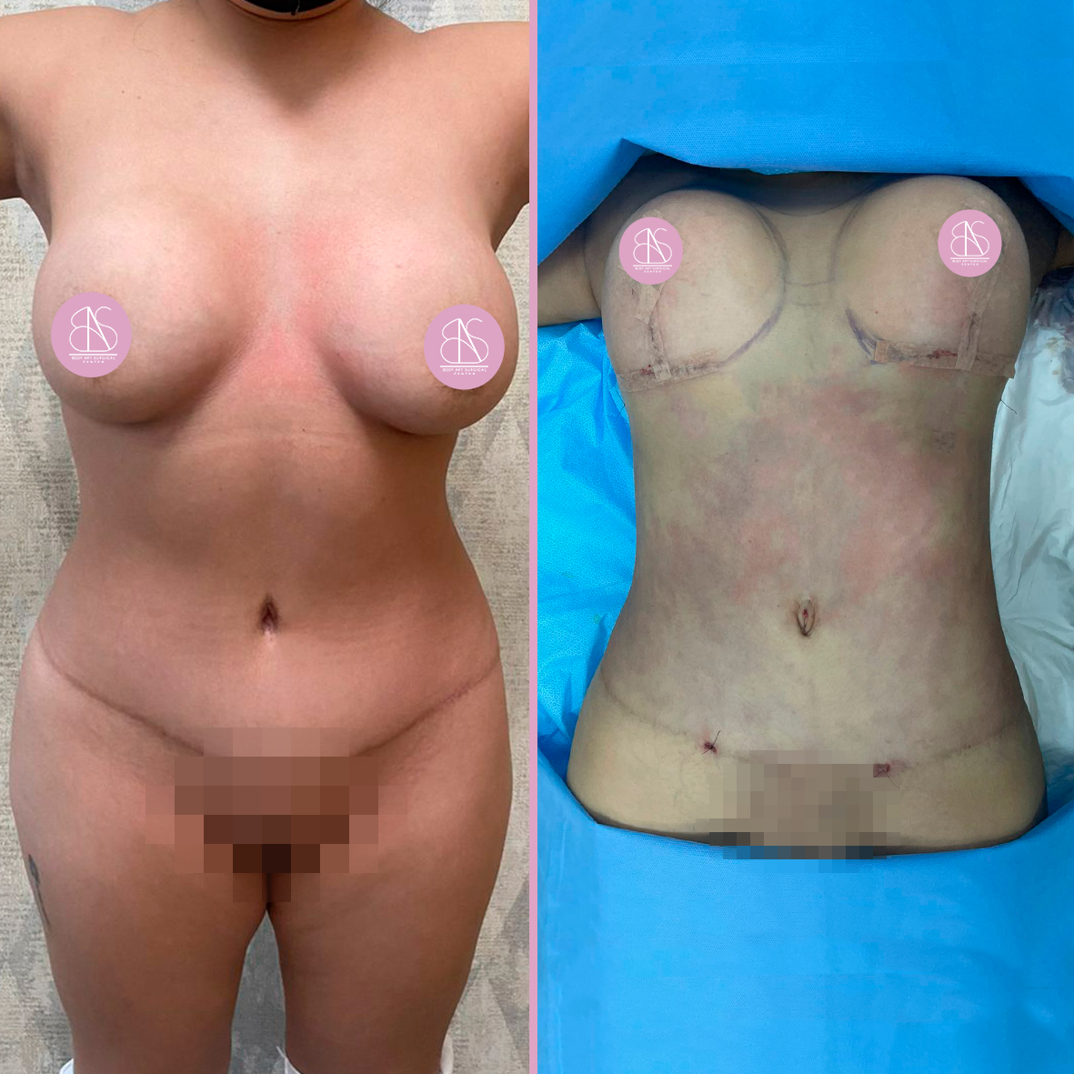 Liposuction Dr Rodriguez 3