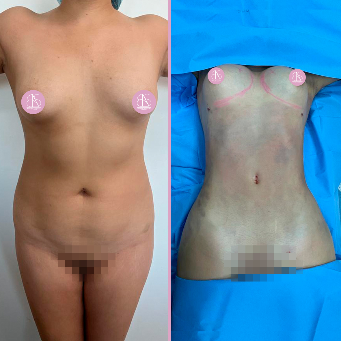 Liposuction Dr Rodriguez 2
