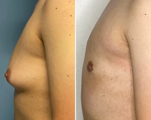 Men-Gynecomasty-2-Flores-NWM