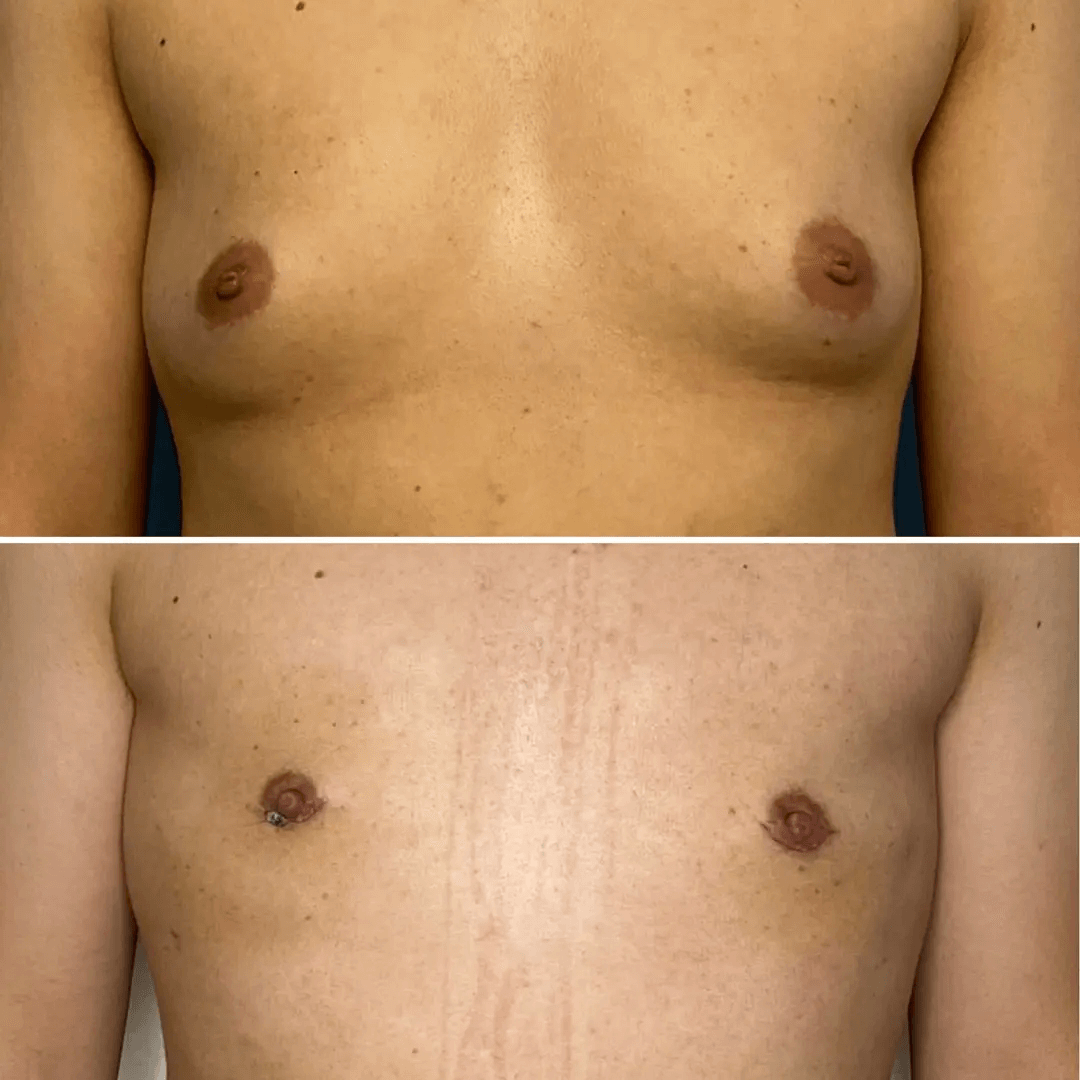 Men-Gynecomasty-3-Flores-NWM-1