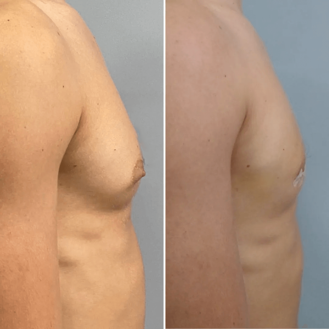 Men-Gynecomasty-4-Flores-NWM-1