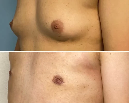 Men-Gynecomasty-Flores-NWM