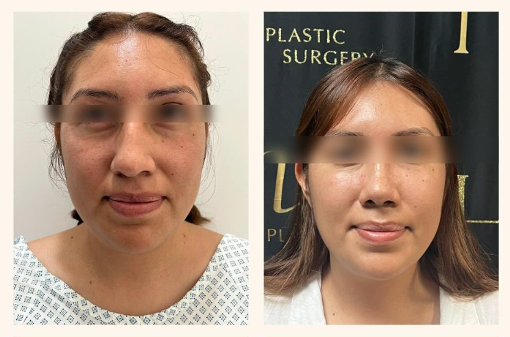 RhinoPlasty-Flores-e1741086633551