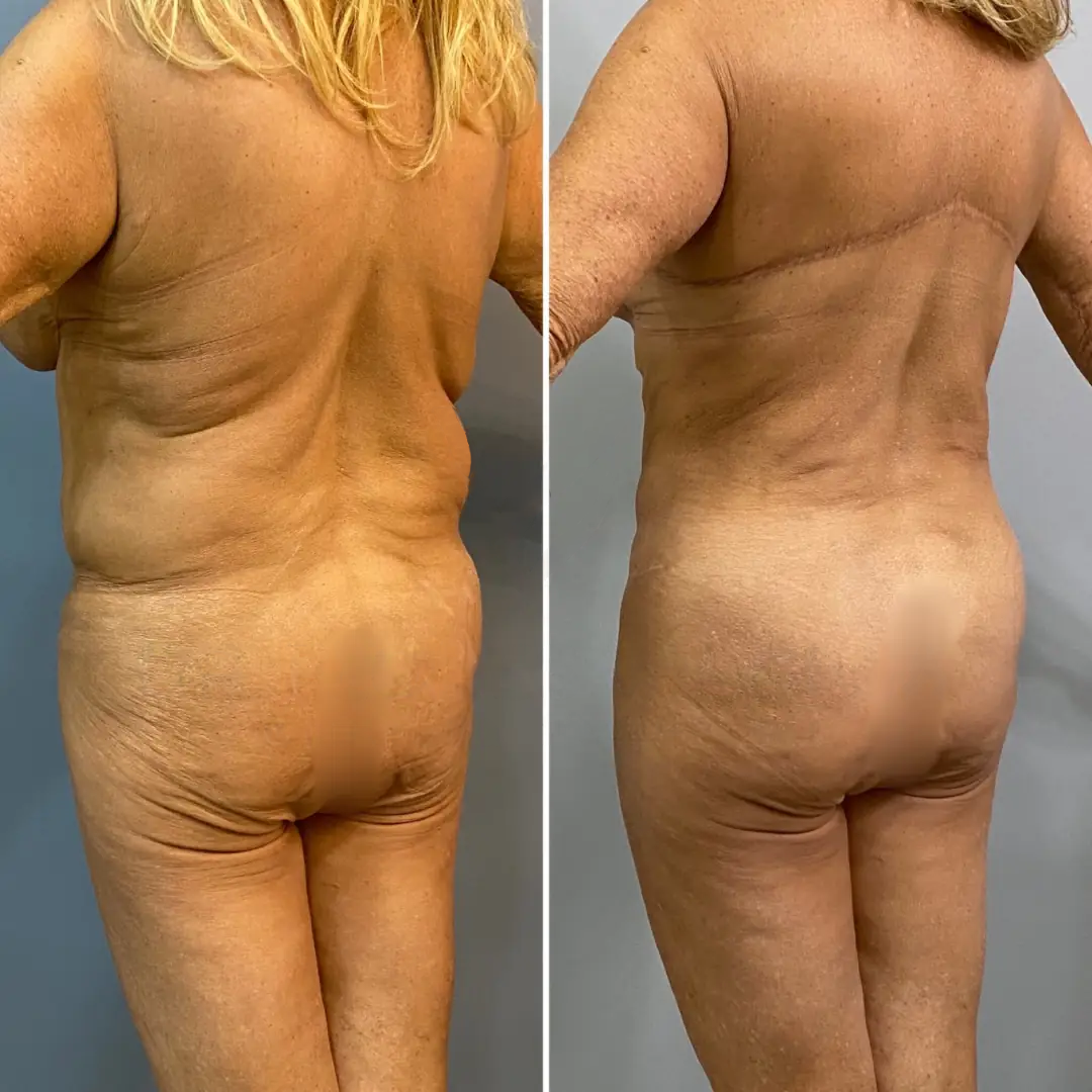 Skin Removal 2 Back Flores NWM