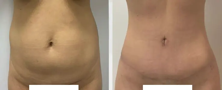 Tummy Tuck Vidal NWM