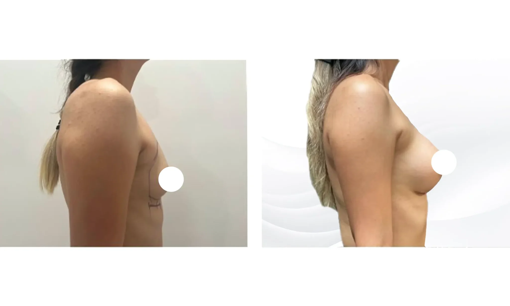 Vidal Breast Aug 4 Scaled