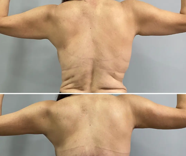 Arm Lift 3 Flores NWM