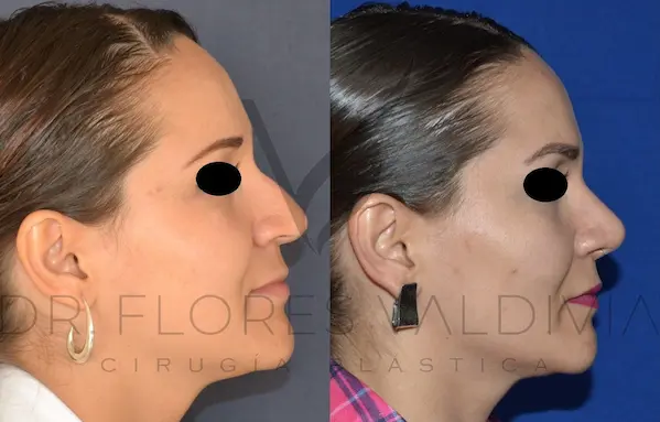 dr-Flores-Rhinoplasty-1