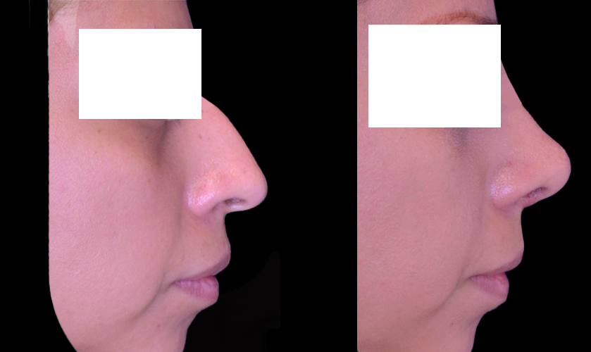 f605885b-9629-4782-9212-cb4360a016a4-female-rhinoplasty