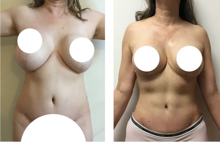 86e91f83-7d1a-4551-afbb-ea044d4c761b-revision-surgery-1024x1024-1