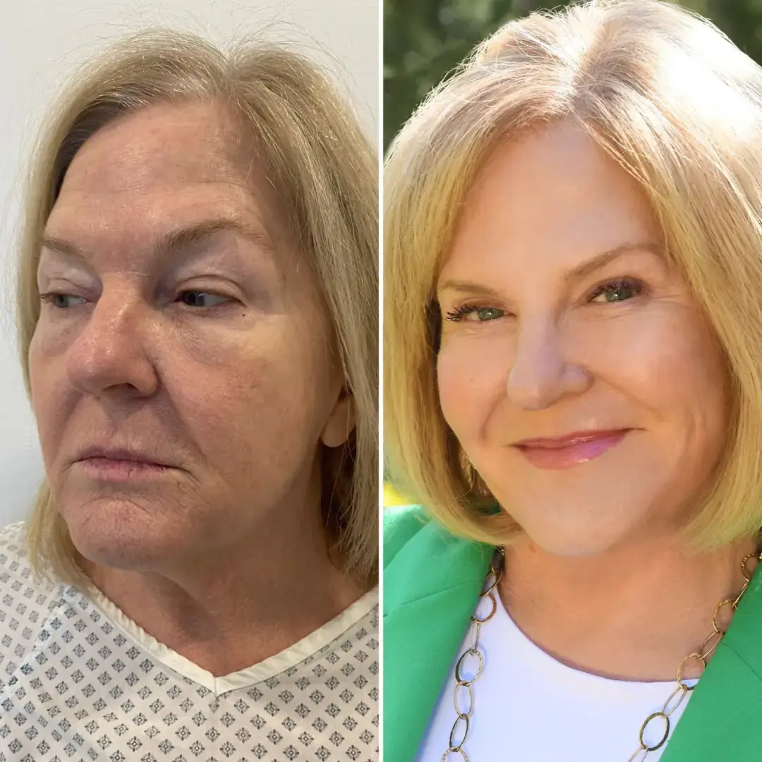 Face Lift