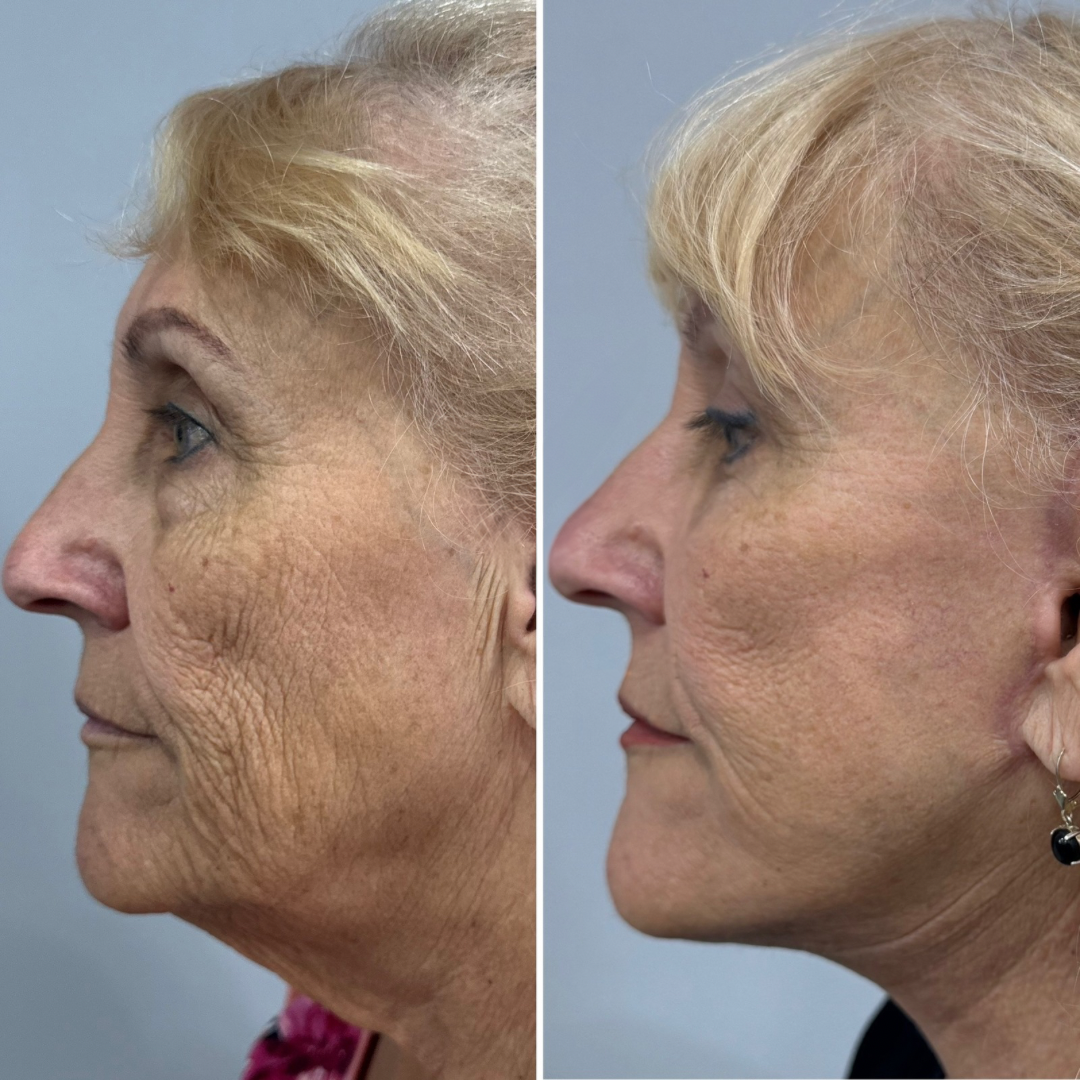 Plastic Surgery Face Lift Mexico
