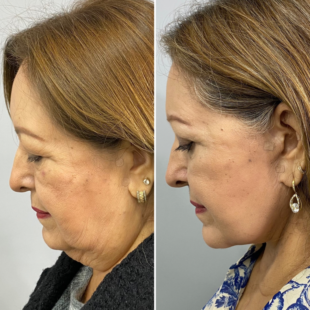 Plastic Surgery Face Lift Mexico