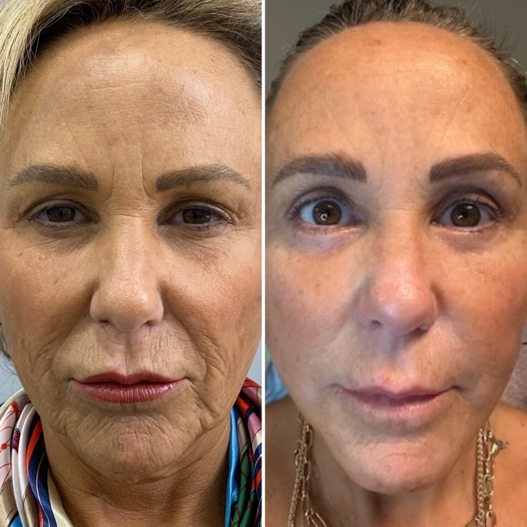 Plastic Surgery Face Lift Mexico