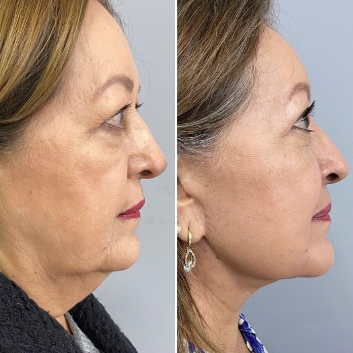 Plastic Surgery Face Lift Mexico