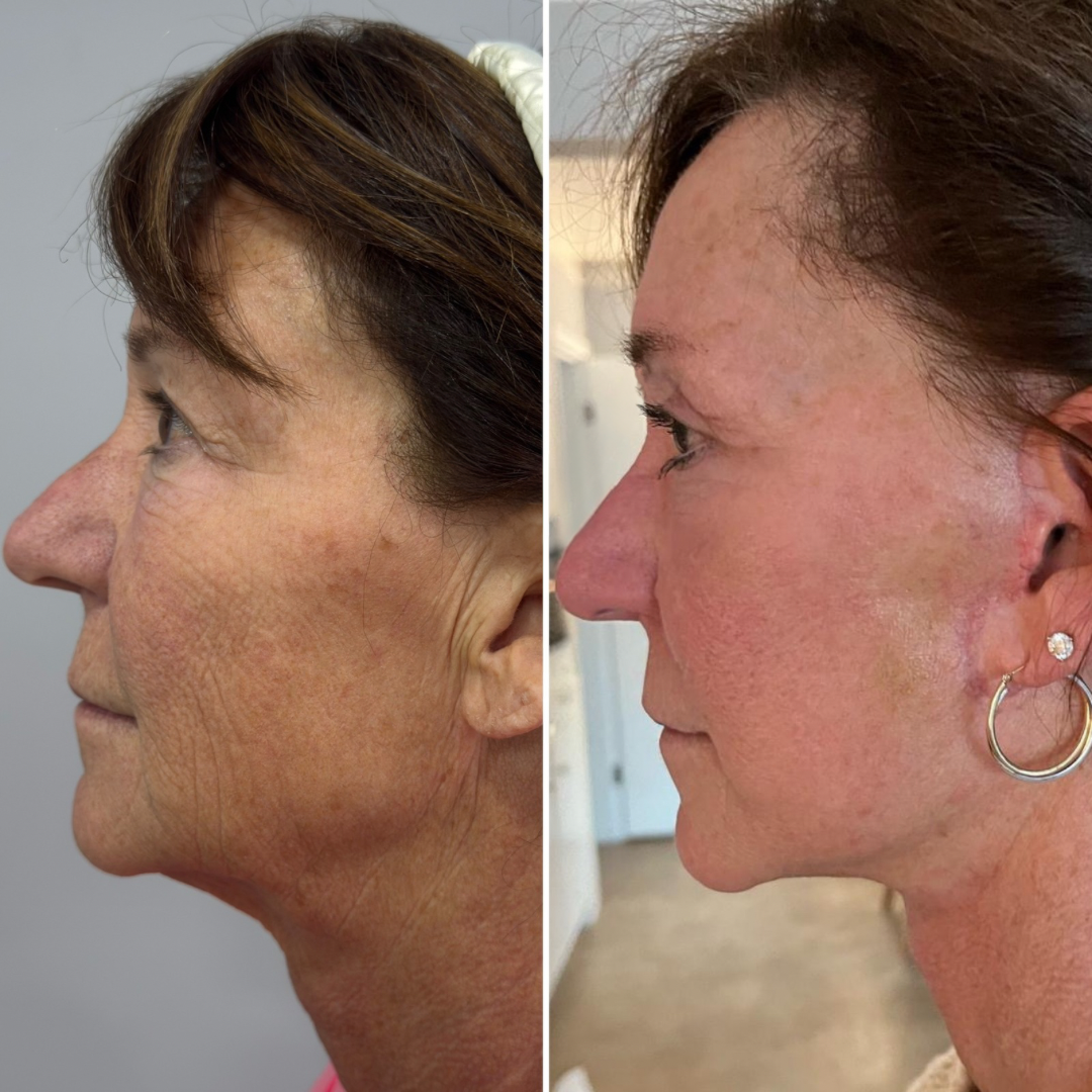 Plastic Surgery Face Lift Mexico