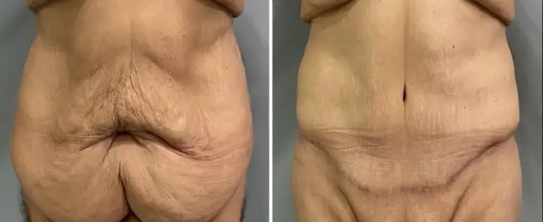 Skin Removal