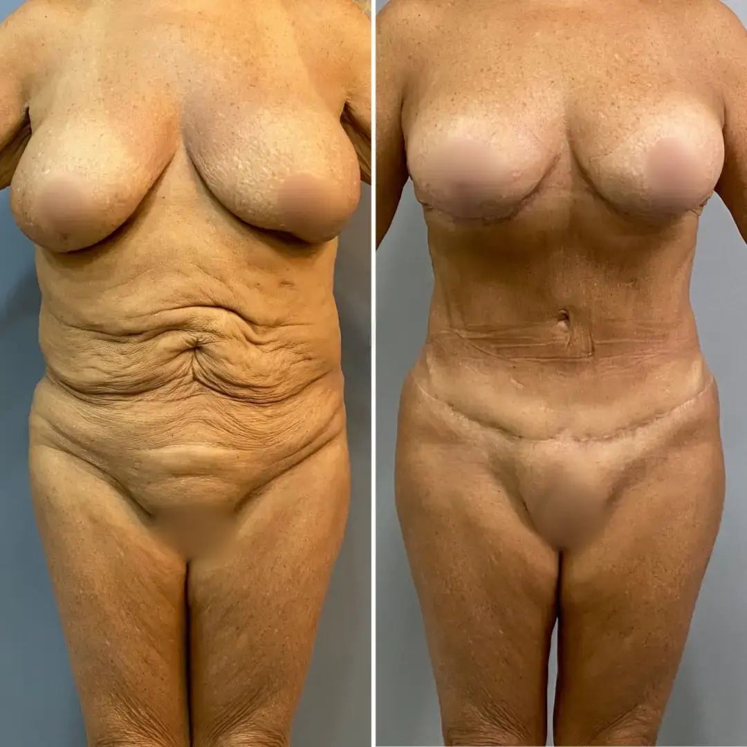 Skin Removal