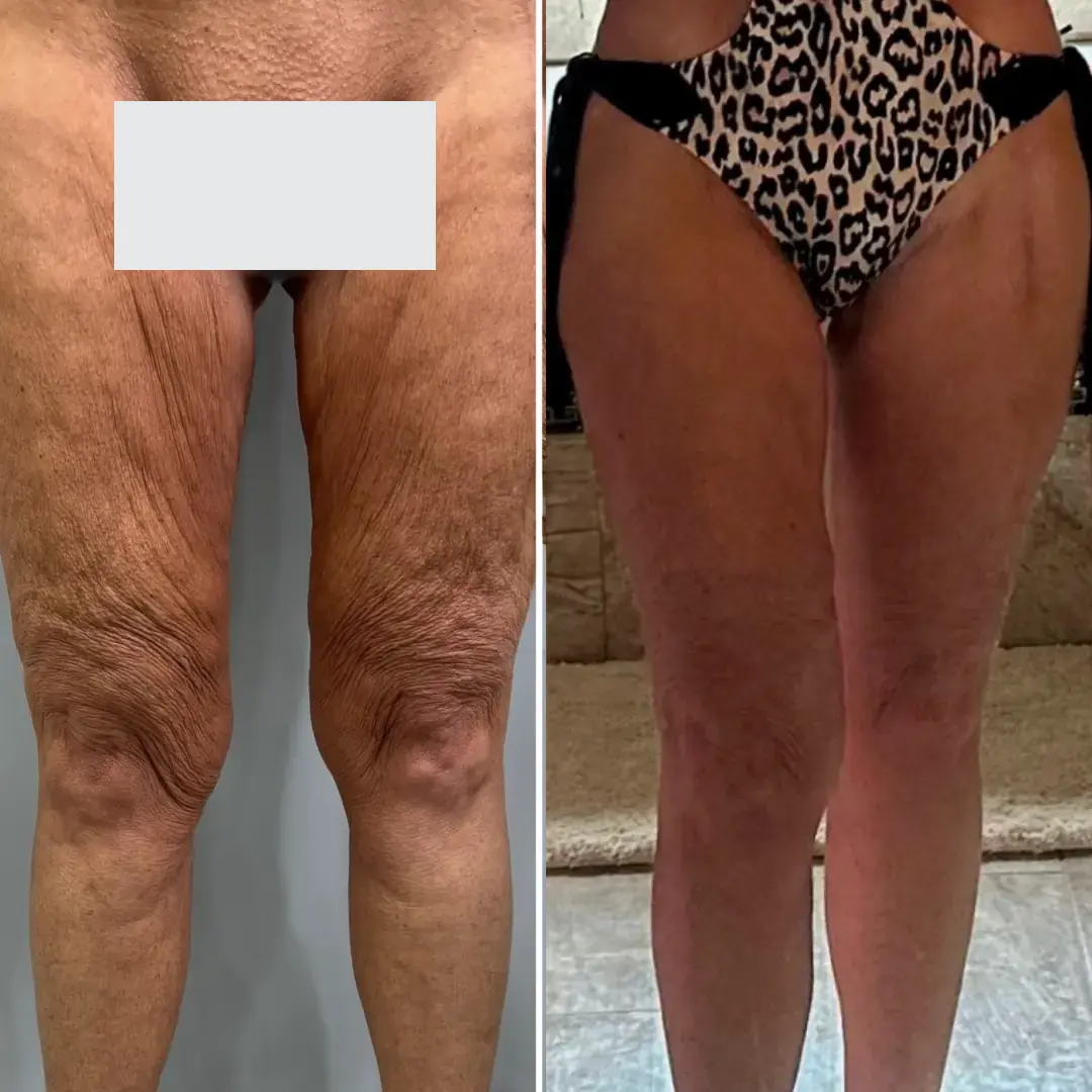 Thigh Lift