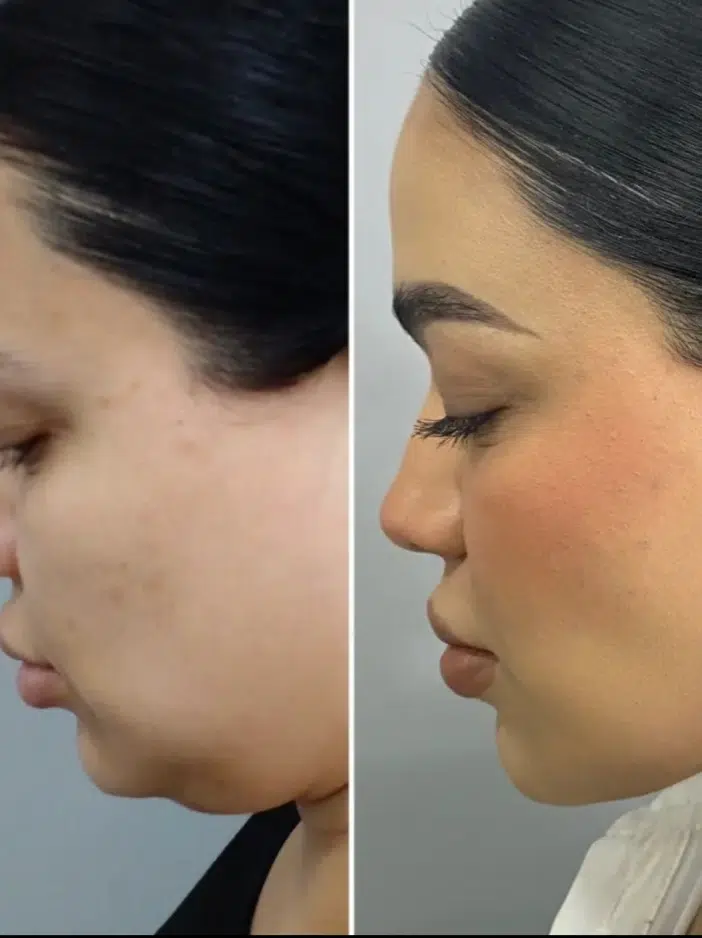 Chin Lipo